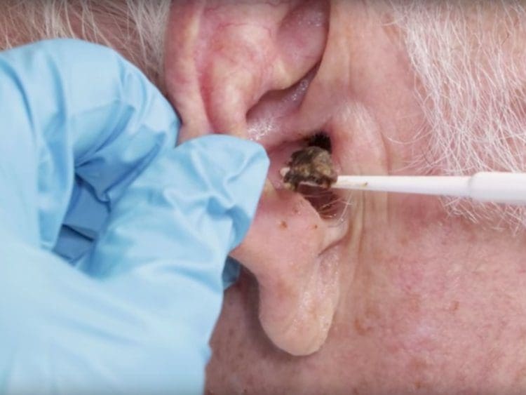 Earwax: How to Prevent Blockages and Buildup